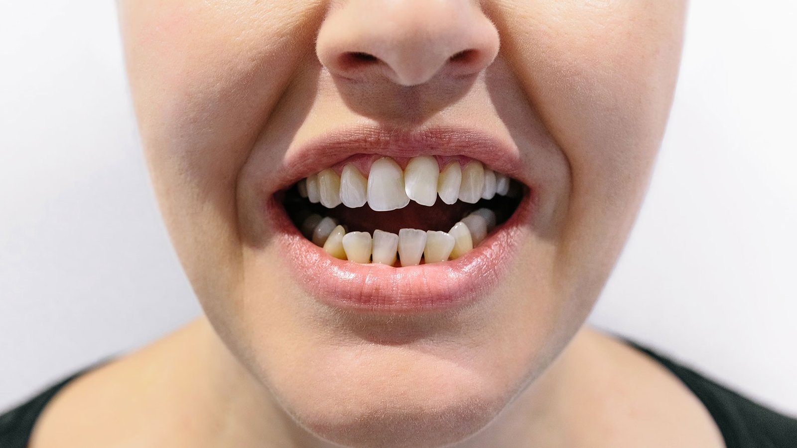 Crowded Teeth Treatment In Dubai Logo