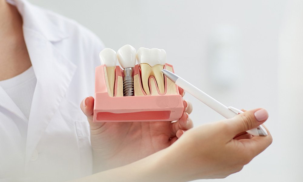 Dental implants Dubai